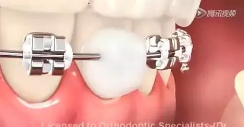 矫正钢丝末端扎嘴怎么解决,矫正钢丝末端扎嘴在家怎么办