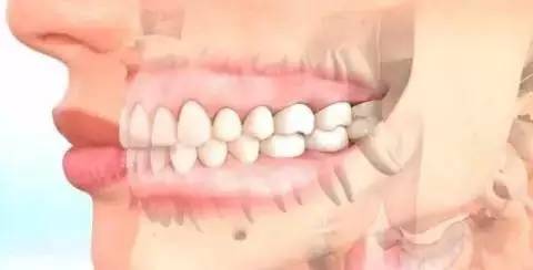 如何一秒钟矫正牙齿,牙齿矫正让你悄然改变从现在开始