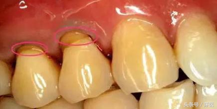 一碰凉水就胃疼,大牙一碰冷热酸甜就疼