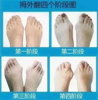 高跟鞋还是少穿吧，许多明星的高颜值，都毁在了一双脚上！