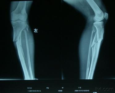 博古特的伤病,博古特扣篮骨折