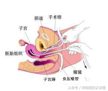 怀孕24周引产后需要怎样调养身体,怀孕28周了孕妇自己关注哪些事项