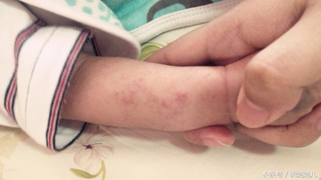 6个月孩子咳嗽起红疹高烧咋回事,宝宝咳嗽起疹子怎么回事