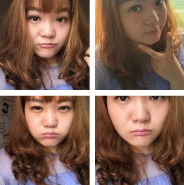 割双眼皮的危害和后遗症,拆双眼皮线痛吗