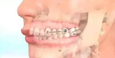 如何一秒钟矫正牙齿,牙齿矫正让你悄然改变从现在开始