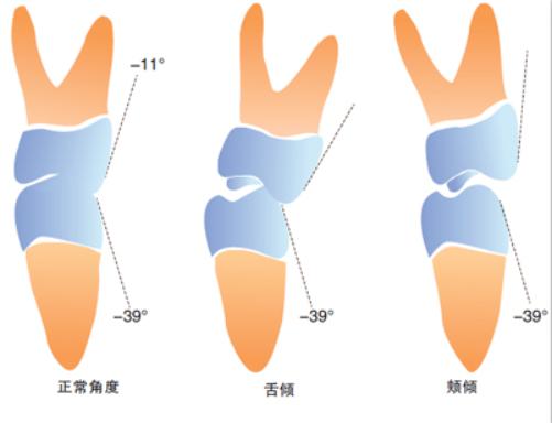 局部矫正牙价格多少,牙齿可以局部矫正吗知乎