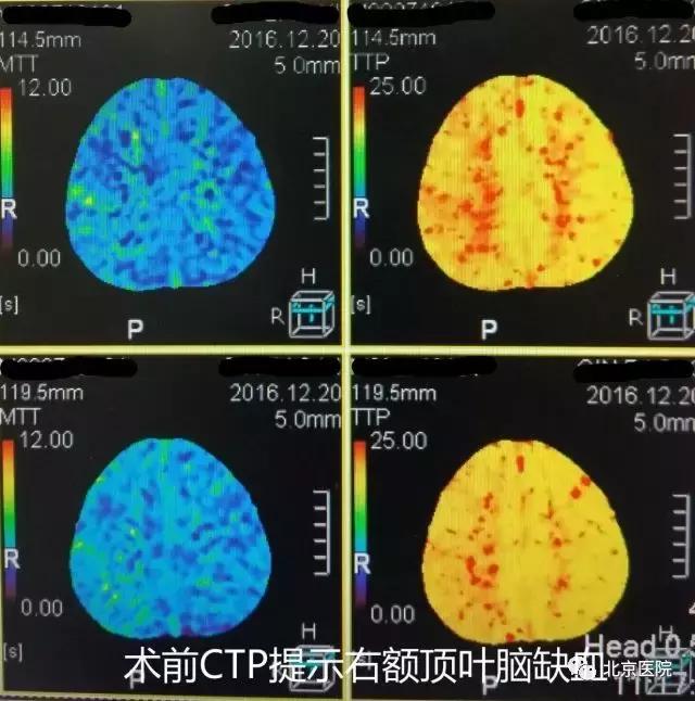 颈动脉狭窄支架手术是微创手术吗,颈动脉狭窄支架手术效果