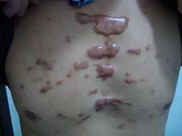 word妈呀！你真的不重视疤痕疙瘩治疗吗？看看这些危害吧