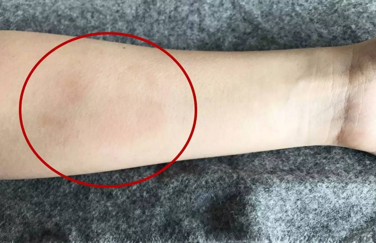 压疮最新指南解读是哪一年的,压疮科普知识