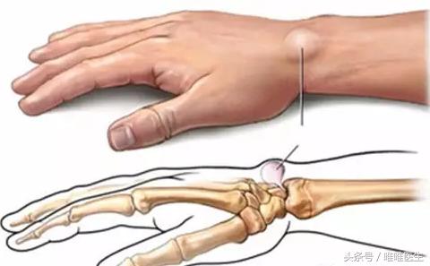 腱鞘炎病理形成原因,手背上的腱鞘炎是怎么样形成的