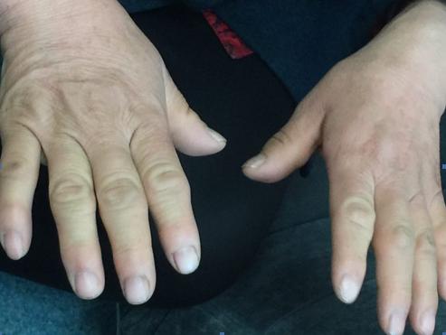 生长激素性垂体腺瘤诊断标准,垂体生长激素瘤首选的治疗方法为