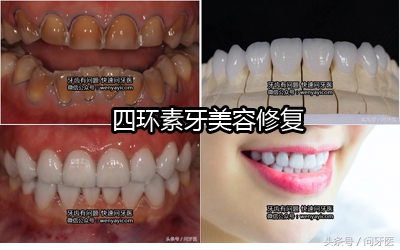 美容冠修复龅牙的利弊,美容冠矫正牙齿怎么样