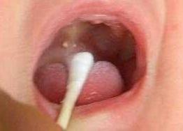 宝宝嘴巴里面有缺口,宝宝嘴巴有一道裂缝