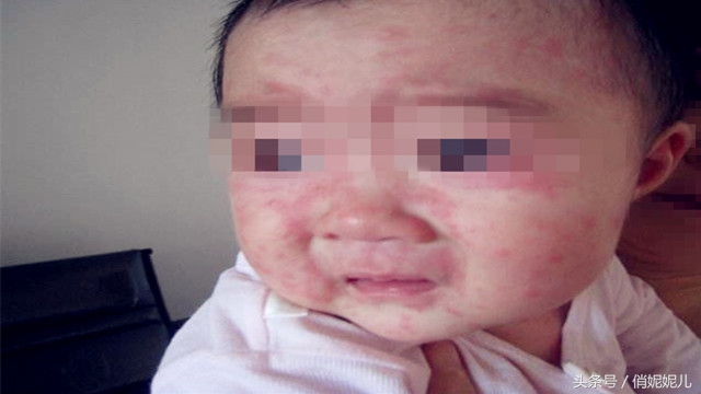 6个月孩子咳嗽起红疹高烧咋回事,宝宝咳嗽起疹子怎么回事