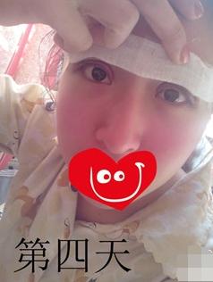 长期用双眼皮胶水变松,长期用胶水粘双眼皮的后果