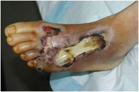 男性糖尿病10个征兆,糖尿病脚上有四种征兆