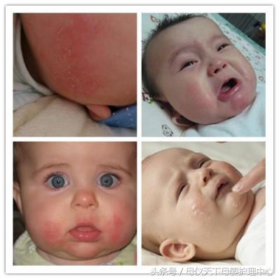 怎么快速解决宝宝湿疹,宝宝湿疹宝妈小妙招