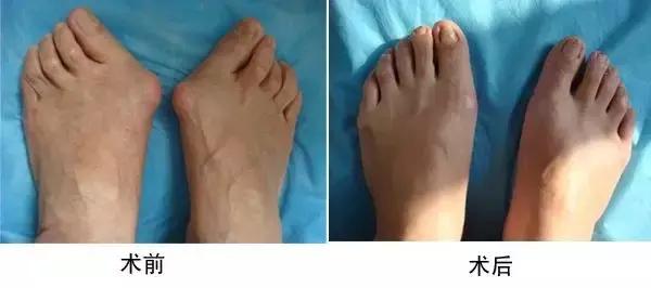 高跟鞋还是少穿吧，许多明星的高颜值，都毁在了一双脚上！