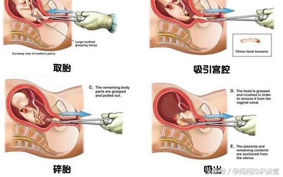 怀孕24周引产后需要怎样调养身体,怀孕28周了孕妇自己关注哪些事项