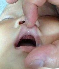 宝宝嘴巴里面有缺口,宝宝嘴巴有一道裂缝