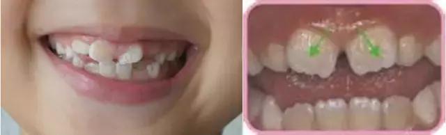 恒牙换牙不,恒牙不长出