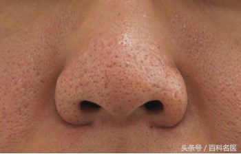 脸多油毛孔粗大黑头粉刺,修复面部毛孔黑头的方法