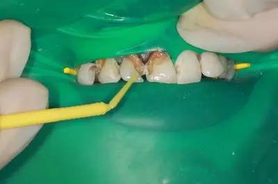 可乐牙治疗实拍,可乐牙治疗好前后图片