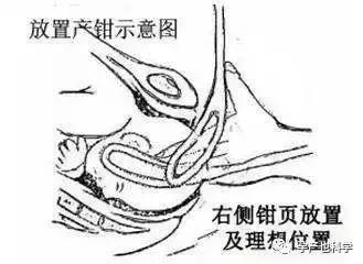 分娩出现这些情况就要产钳助产了！产钳助产风险有哪些？