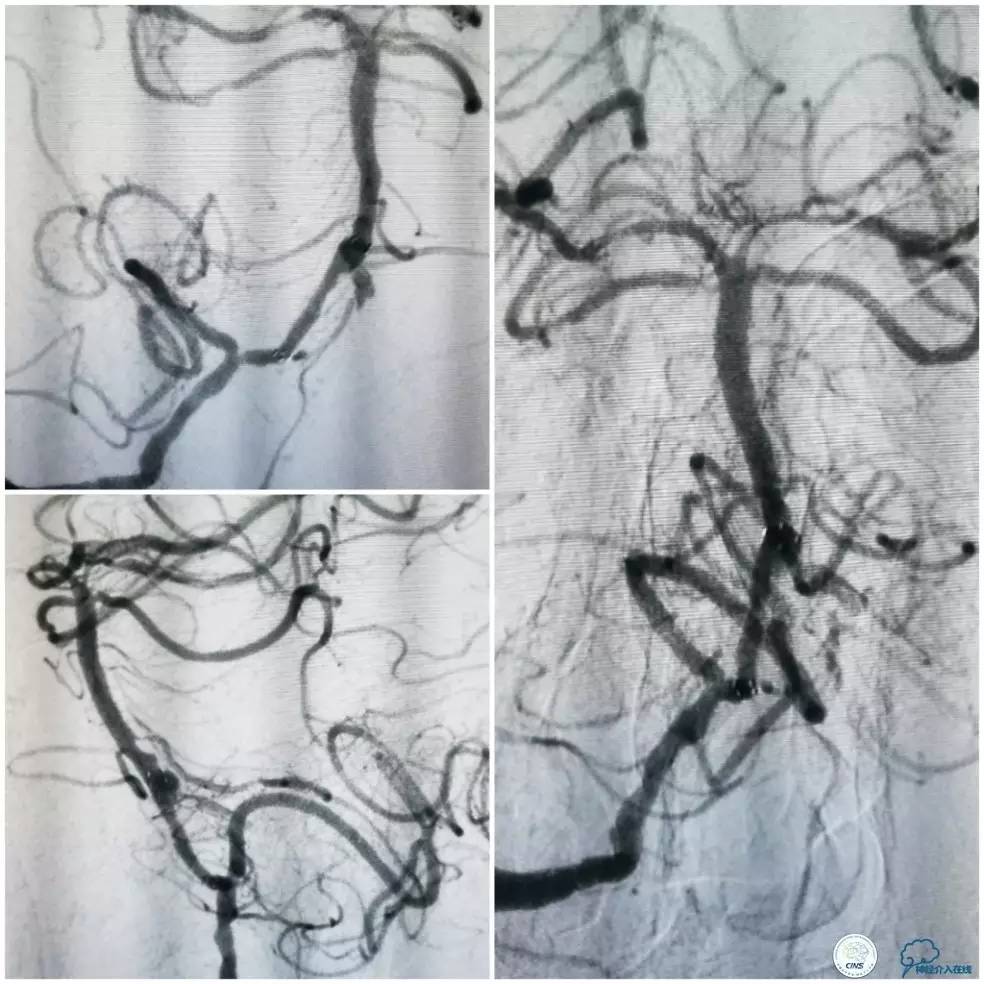 天坛周记｜右椎动脉V1段及V4-基底动脉串联病变支架治疗一例