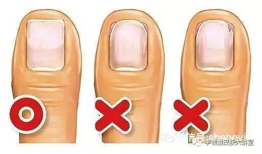 大脚趾甲有点轻微的嵌甲怎么处理,嵌甲手术后指甲还能恢复原样吗