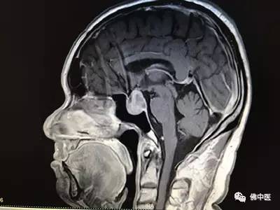 「赞」打开上帝之窗—佛中医经鼻腔切除颅内肿瘤