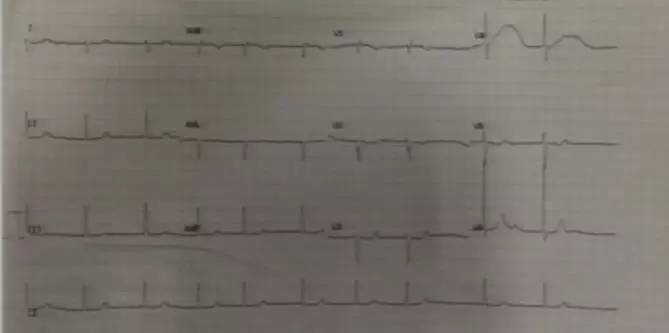 心脏增大引发的心衰能治好吗,急性心衰引起心脏扩大能治愈吗