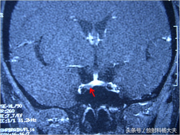 垂体腺瘤乳房还分泌乳汁是咋回事,乳房垂体有问题是什么症状
