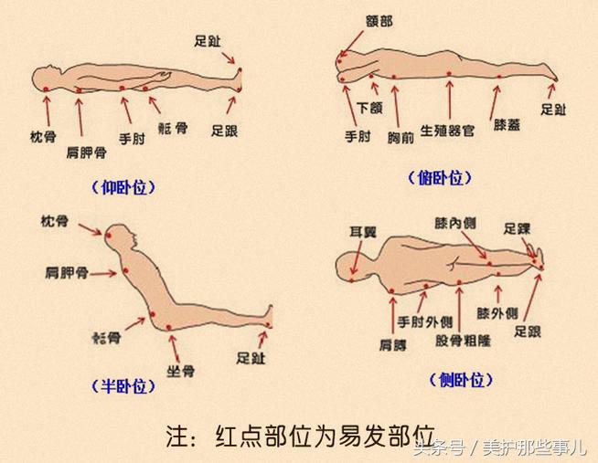 褥疮用酒精敷伤口行吗,用酒精消毒能治褥疮吗
