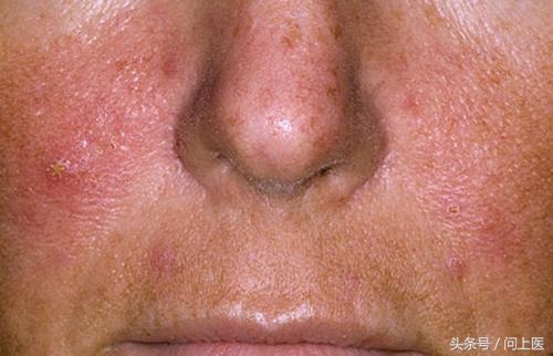 人常见的皮肤病,十二种最常见的皮肤问题对照图