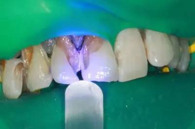 可乐牙治疗实拍,可乐牙治疗好前后图片