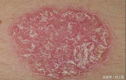 人常见的皮肤病,十二种最常见的皮肤问题对照图