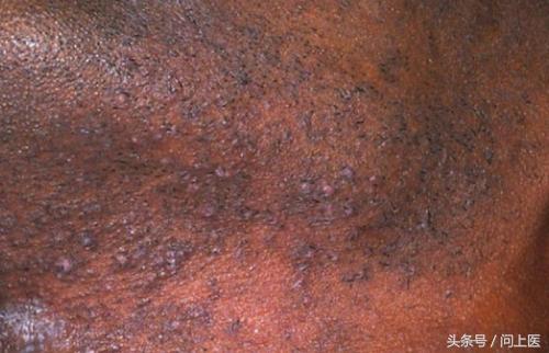 人常见的皮肤病,十二种最常见的皮肤问题对照图