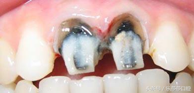 烤瓷牙牙基烂没了怎么办,烤瓷牙会变形状吗