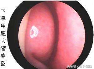 鼻子一直不通气是为什么,鼻子总不通气怎么治