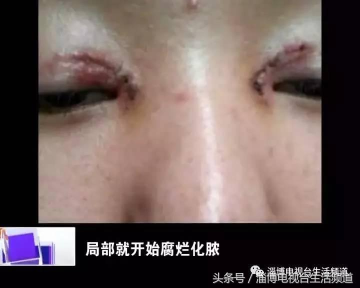 女子开眼角半年后遭罪再找店家工作人员却坚称不认识她