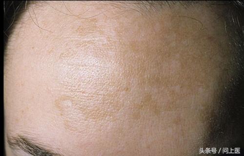 人常见的皮肤病,十二种最常见的皮肤问题对照图