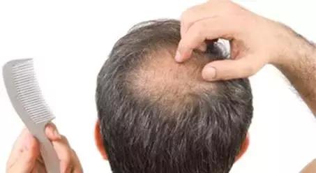 神经性脱发的原因,怎么确定是不是神经性引起的脱发