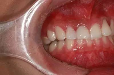 可乐牙治疗实拍,可乐牙治疗好前后图片