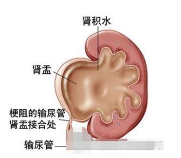 胎儿肾积水越来越多怎么办,胎儿肾积水是什么原因导致的