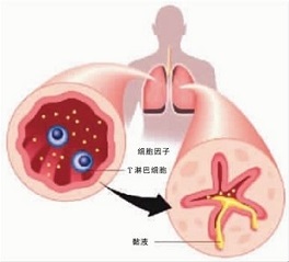 哮喘呼吸不畅快,哮喘如何治愈最快