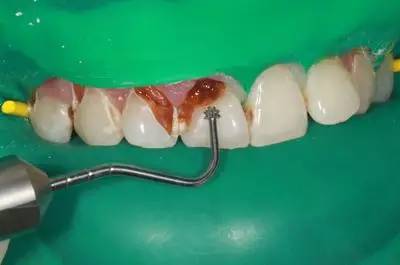 可乐牙治疗实拍,可乐牙治疗好前后图片