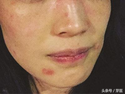 身上长桃花癣怎么回事,入春脸突然痒怎么回事