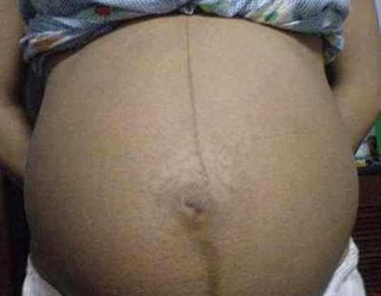 怀孕看肚子上的线准吗偏左偏右,怎么看妊娠线偏左还是偏右图片