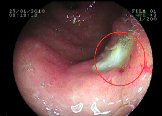 国医大师沈绍功：得了胃溃疡别着急，我有个家传的方子给你！